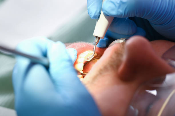 Best Emergency Root Canal Treatment in Waxhaw, NC